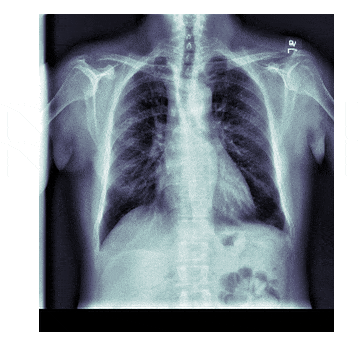 Chest XRays